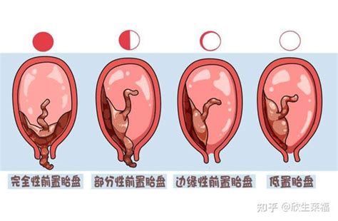 胎盤前置|前置胎盘